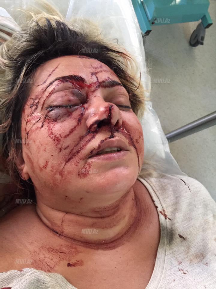 Anası azərbaycanlı modeli ölümdən xilas etdi, özü isə...