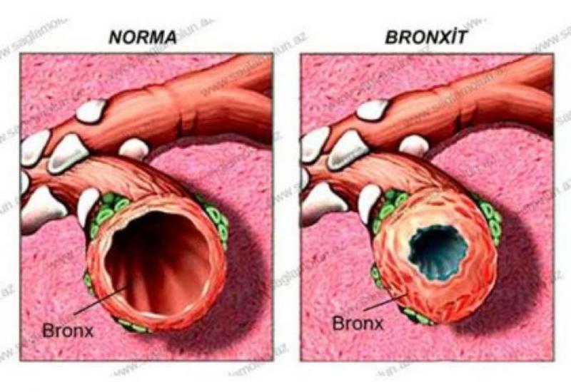 Bronxitin əlamətləri