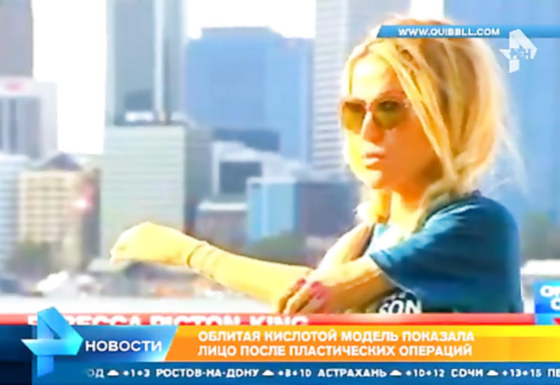 Облитая кислотой модель показала свое лицо после пластики