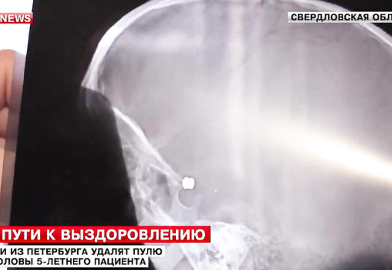 Мальчик живет с пулей в голове