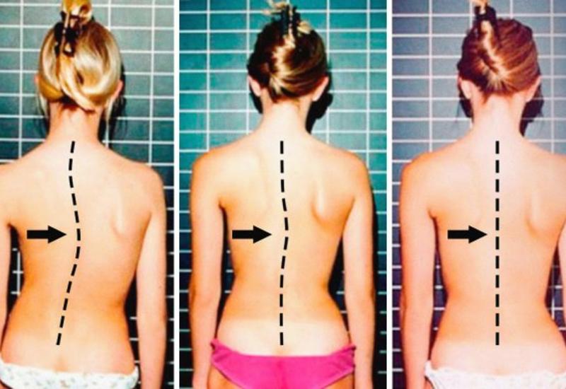 7 крутых упражнений, чтобы построить ровный позвоночник