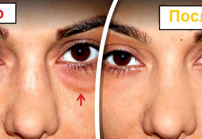 Как уменьшить мешки под глазами: 5 лучших домашних средств