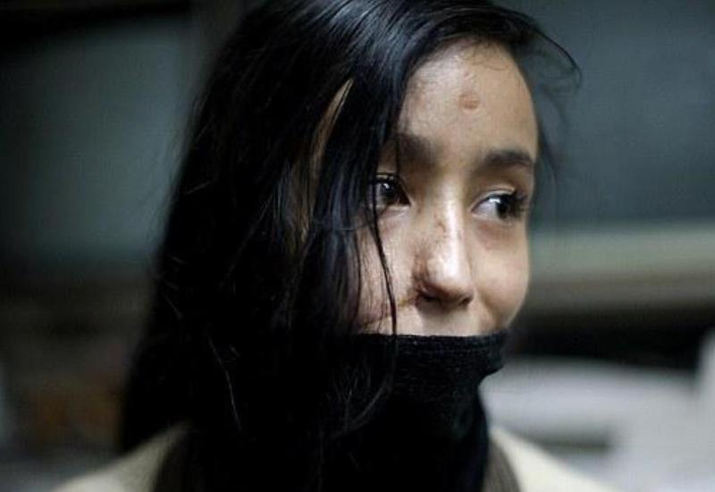 DƏHŞƏT: Bu ölkədə qadınların üzü yandırılır