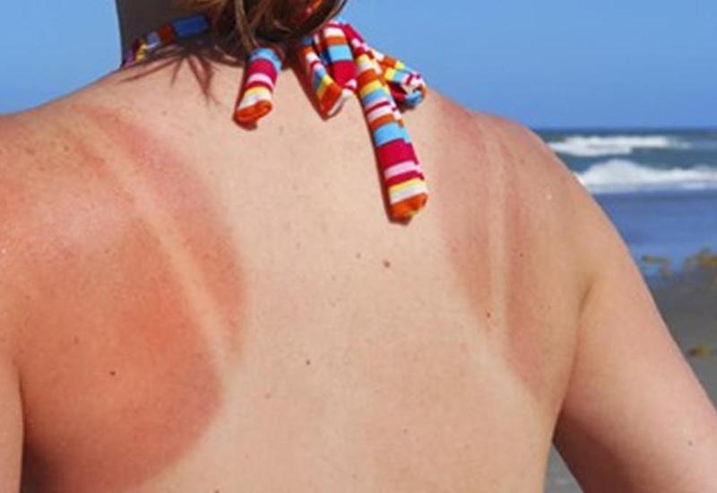 Bu xəstəlikləri olanlara gündə qaralmaq olmaz