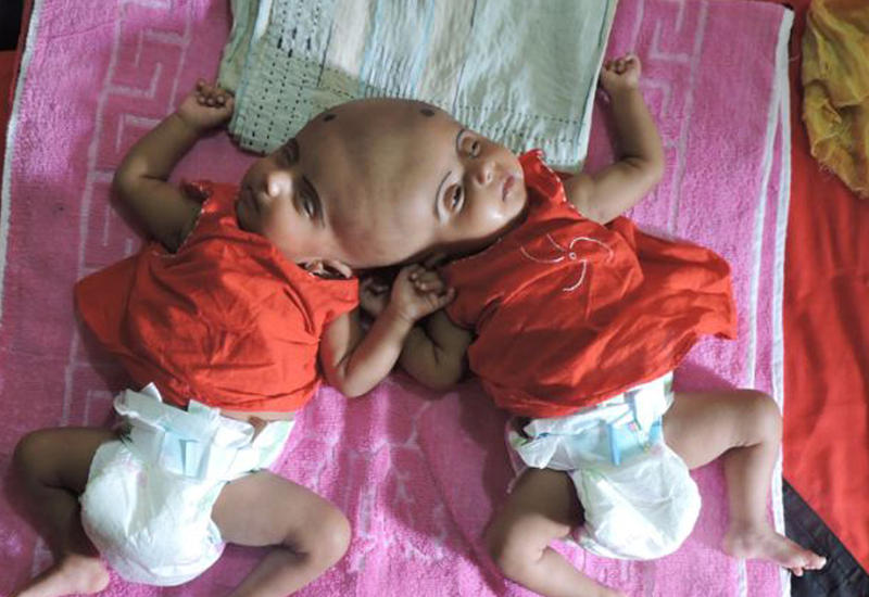 В Бангладеш родились близнецы с одной головой на двоих