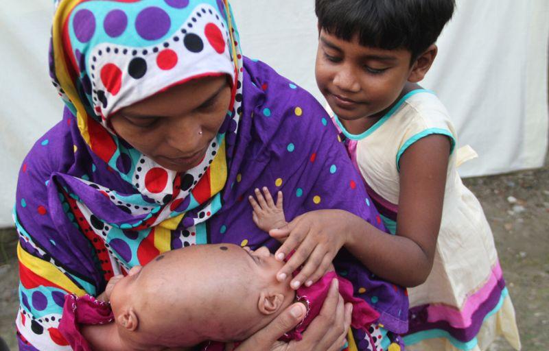 В Бангладеш родились близнецы с одной головой на двоих
