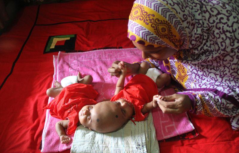 В Бангладеш родились близнецы с одной головой на двоих