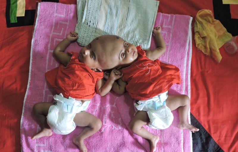 В Бангладеш родились близнецы с одной головой на двоих