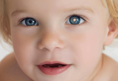 Как с помощью простой фотографии определить рак глаза у ребенка <span class="color_red">- ФОТО</span>