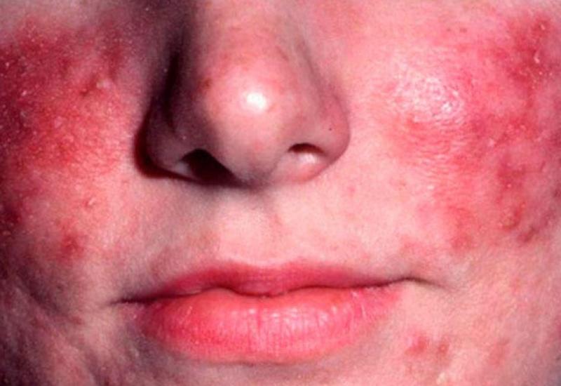 Yanaqlarda qırmızı-irinli səpgilər varsa...