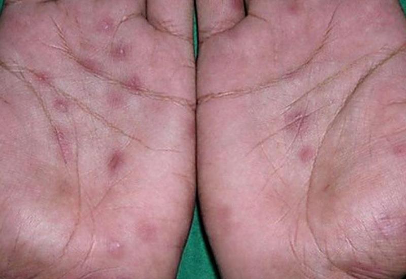 Eritema və onun növləri