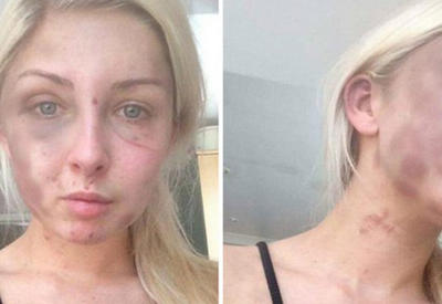 Парень забил свою девушку до полусмерти за пачку сигарет <span class="color_red">- ФОТО</span>