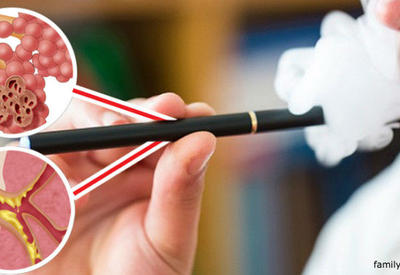 Электронные сигареты вызывают неизлечимую болезнь «Попкорн легких»