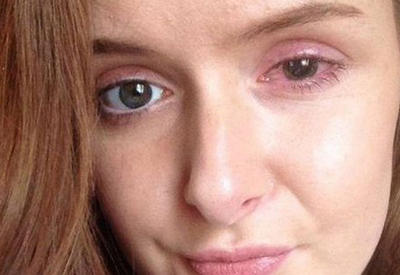 Самые страшные опасения насчет ношения линз подтвердились! <span class="color_red">- ФОТО</span>