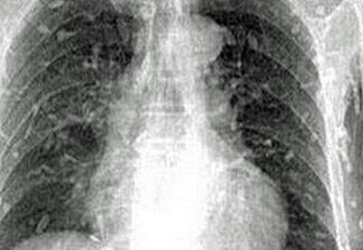 Тело мужчины полностью покрылось глистами после употребления суши <span class="color_red">- ФОТО</span>