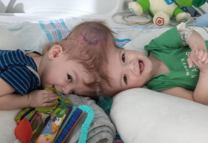 Разделенные сиамские близнецы впервые посмотрели друг на друга