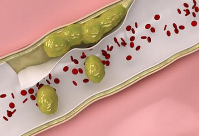 9 продуктов, которые помогут очистить артерии естественным образом