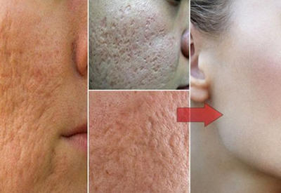 Всего один ингредиент и вы забудете о порах на лице!