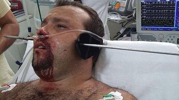 Голову мужчины проткнула стрела для подводной охоты