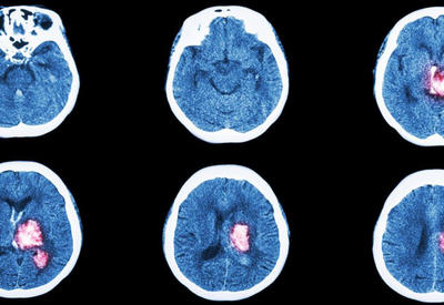 6 признаков инсульта, при которых нужно действовать немедленно
