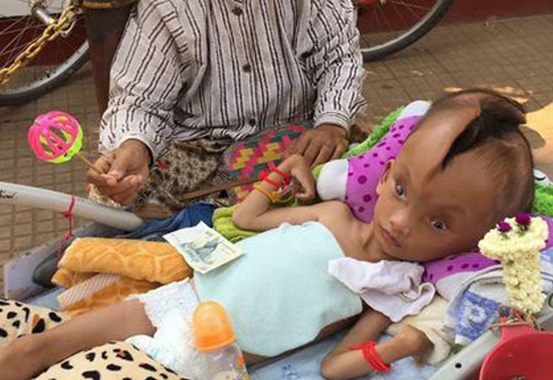 Малыш родился с жуткой трещиной в черепе