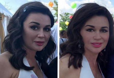 Заворотнюк удаляет из Инстаграма вопросы о том, что случилось с ее лицом!