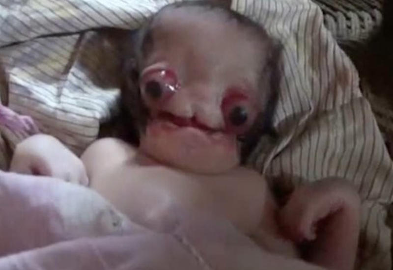 В Индии родился ребёнок-мутант