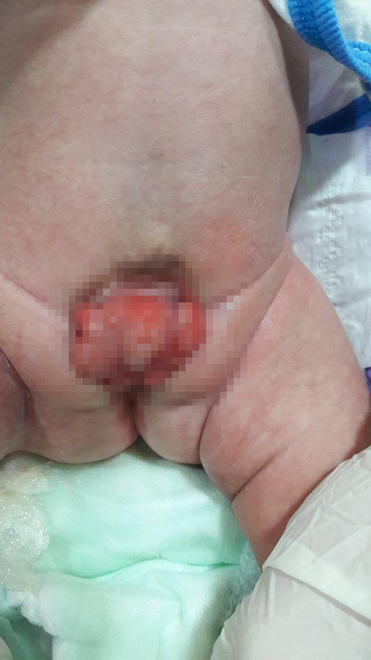 Azərbaycanda sidik kisəsi çöldə olan uşaq doğuldu