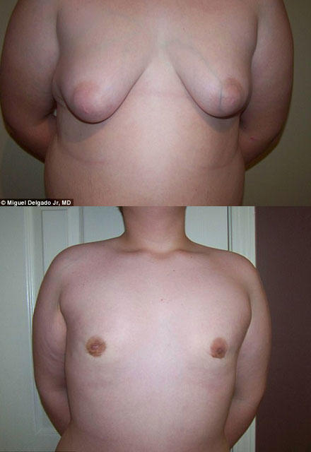 Kişilərin döşü niyə böyüyür?