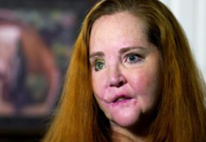 Женщина лишила себя челюсти и не пожалела