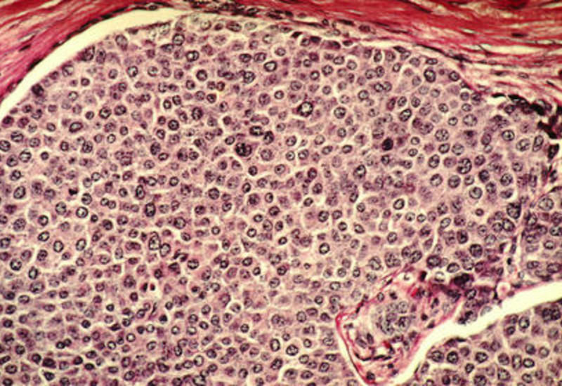 Создан препарат против невосприимчивого к лечению рака