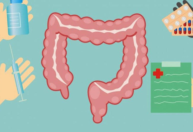 Appendisiti əməliyyatsız müalicə etmək mümkündürmü?