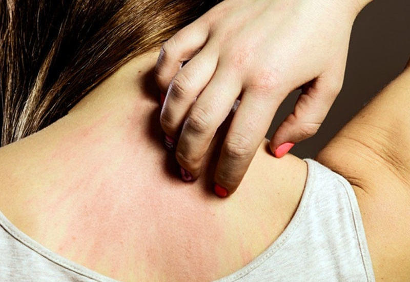 Allergiya nədir?