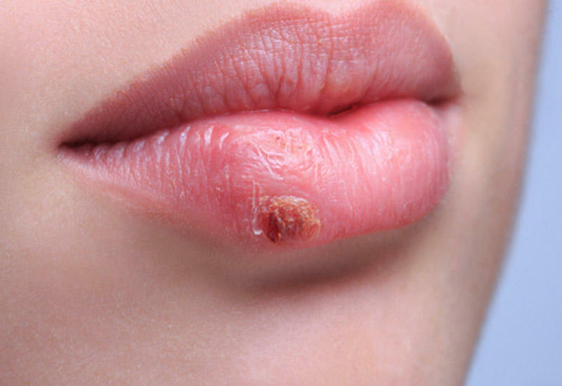 Herpes haqda biməkdikləriniz faktlar