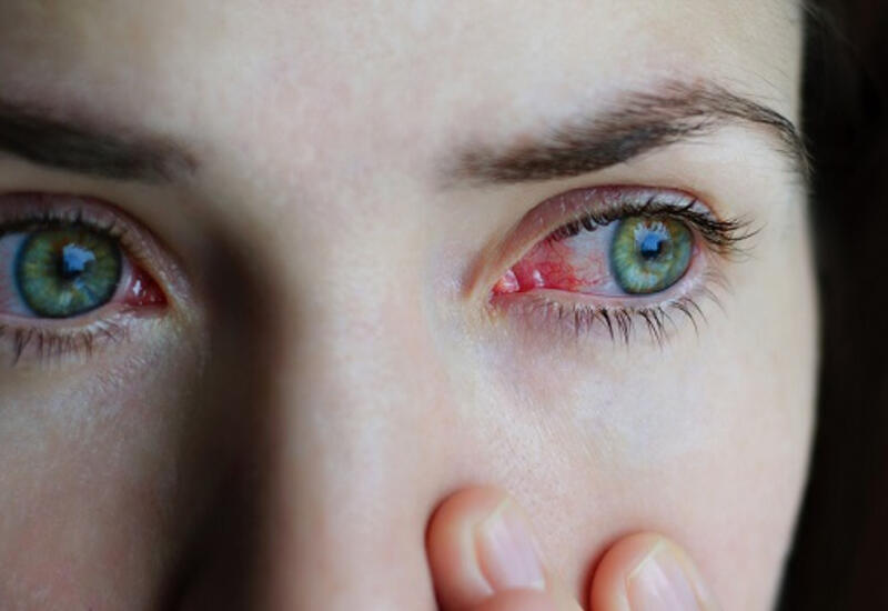Врач раскрыл опасные причины покраснения глаз