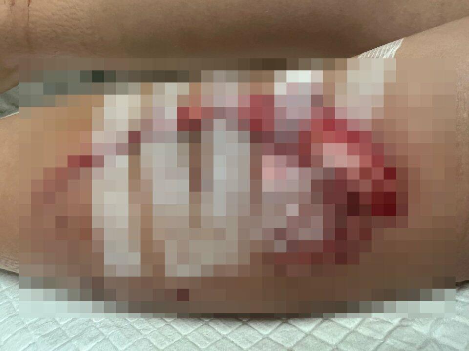 Акулы разодрали ноги восьмилетнему мальчику