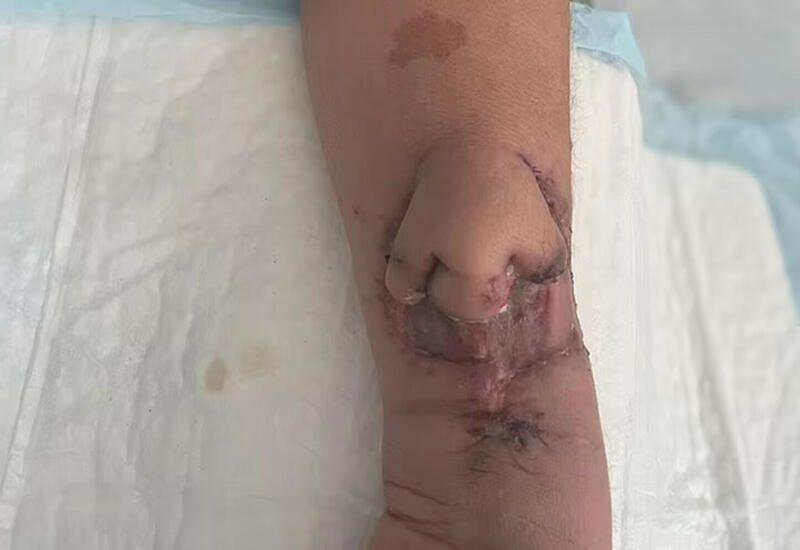 На руке вырастили нос, который пересадили на лицо