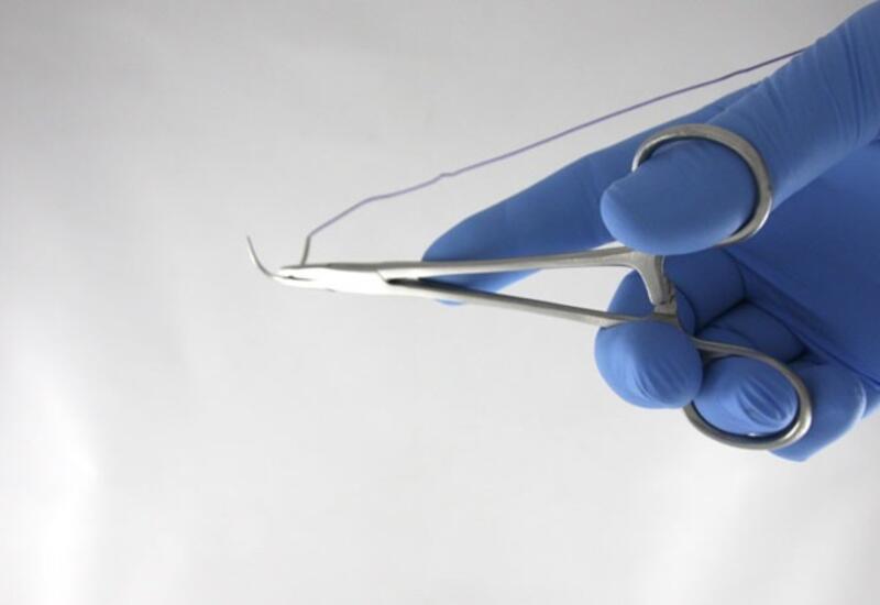 Жительница Колумбии страдала 11 лет от нитки с иголкой, забытой внутри ее тела