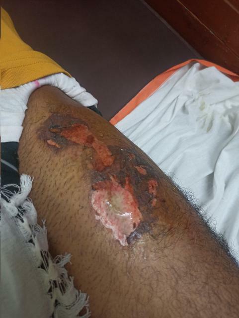 Смартфон OnePlus взорвался в кармане своего владельца