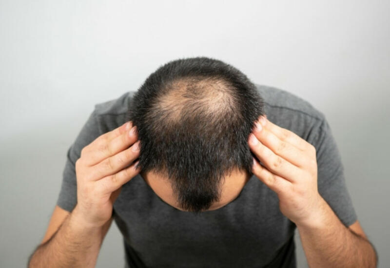 Saç tökülməsinə səbəb ola biləcək