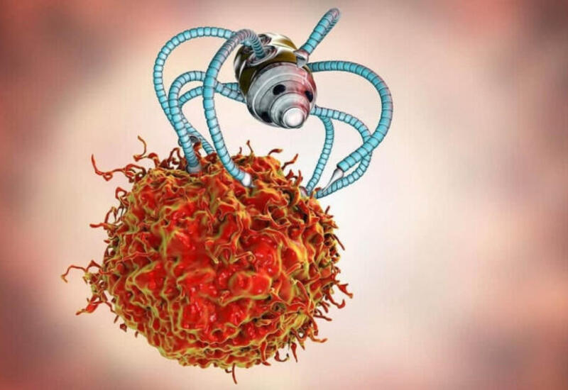 Sinə ağrısı sandı, nadir rast gəlinən şiş aşkarlandı