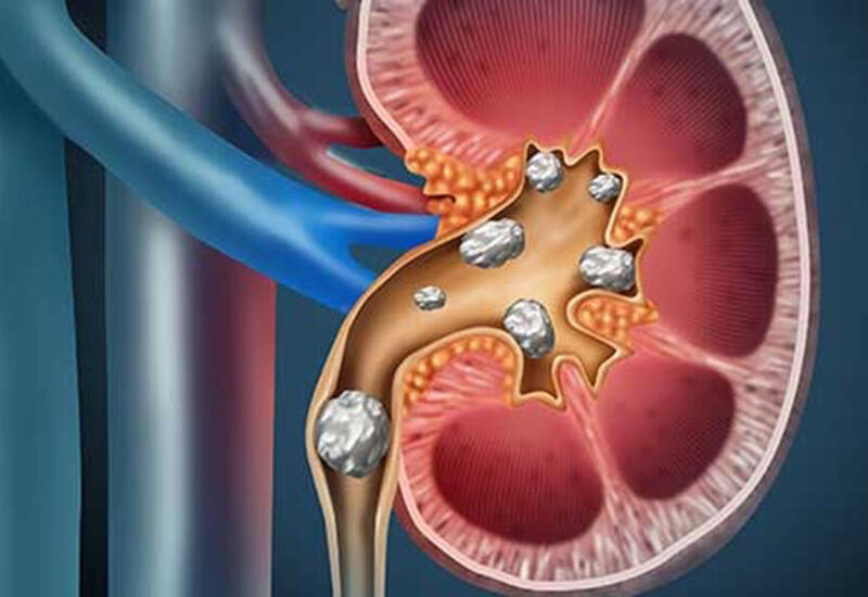 Выявили неочевидный признак болезни почек