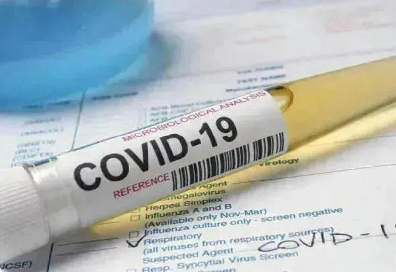 Azərbaycanda bir ayda 514 nəfər COVID-19-a yoluxub