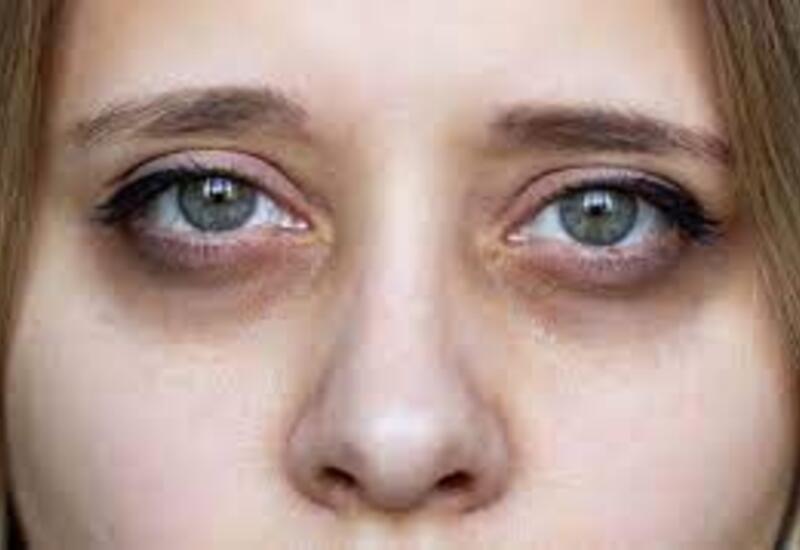 Gözaltı qaralmanın 3 səbəbi