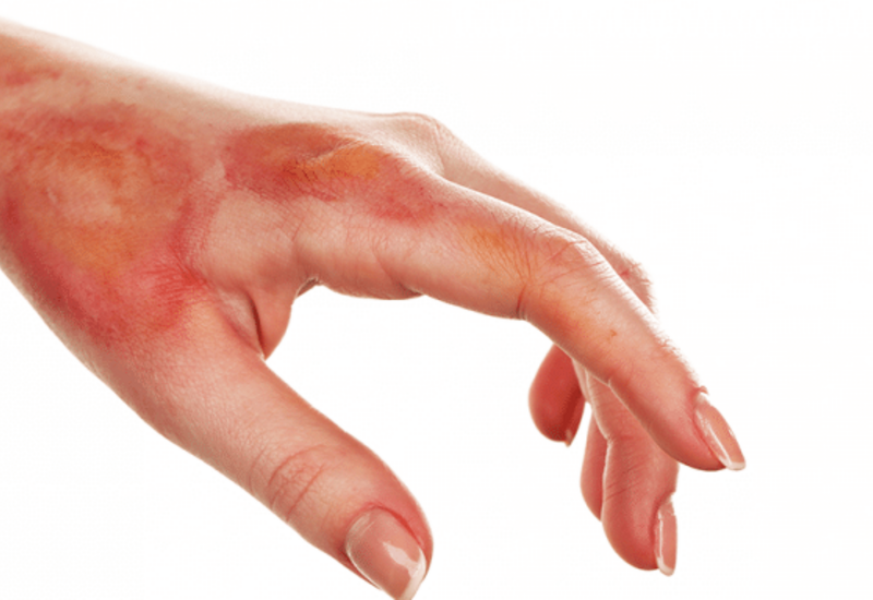 Yanıqlar zamanı ilk yardım nə