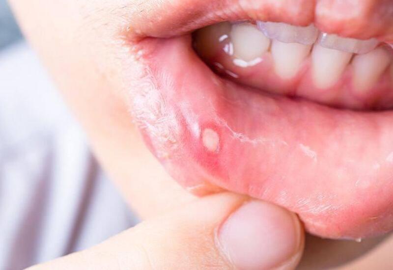 Stomatiti bir gecədə sağaldan çarə