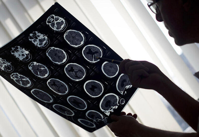 Обнаружены следы микропластика в человеческом мозге