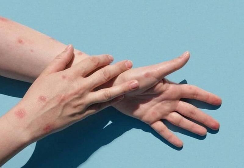 Meymunçiçəyinin əlamətləri nələrdir?