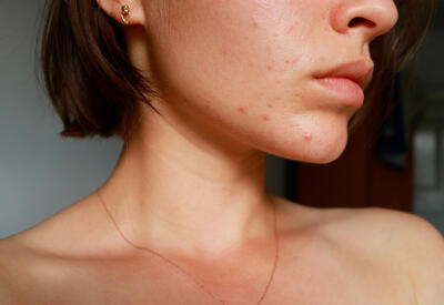 Назван эффективный с древности способ маскировки прыщей