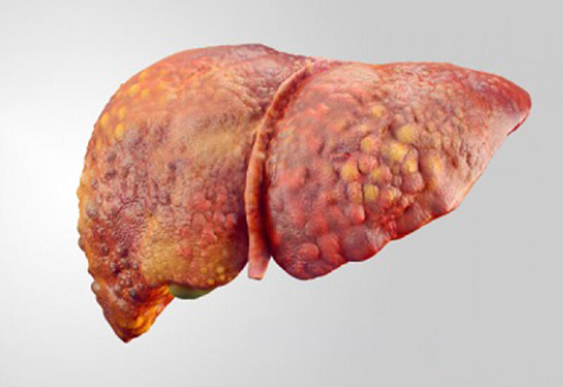 Найден ген, защищающий печень от ожирения